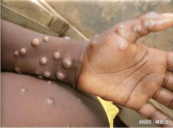 世卫拉响警报！非洲爆发新猴痘疫情致近600人死亡